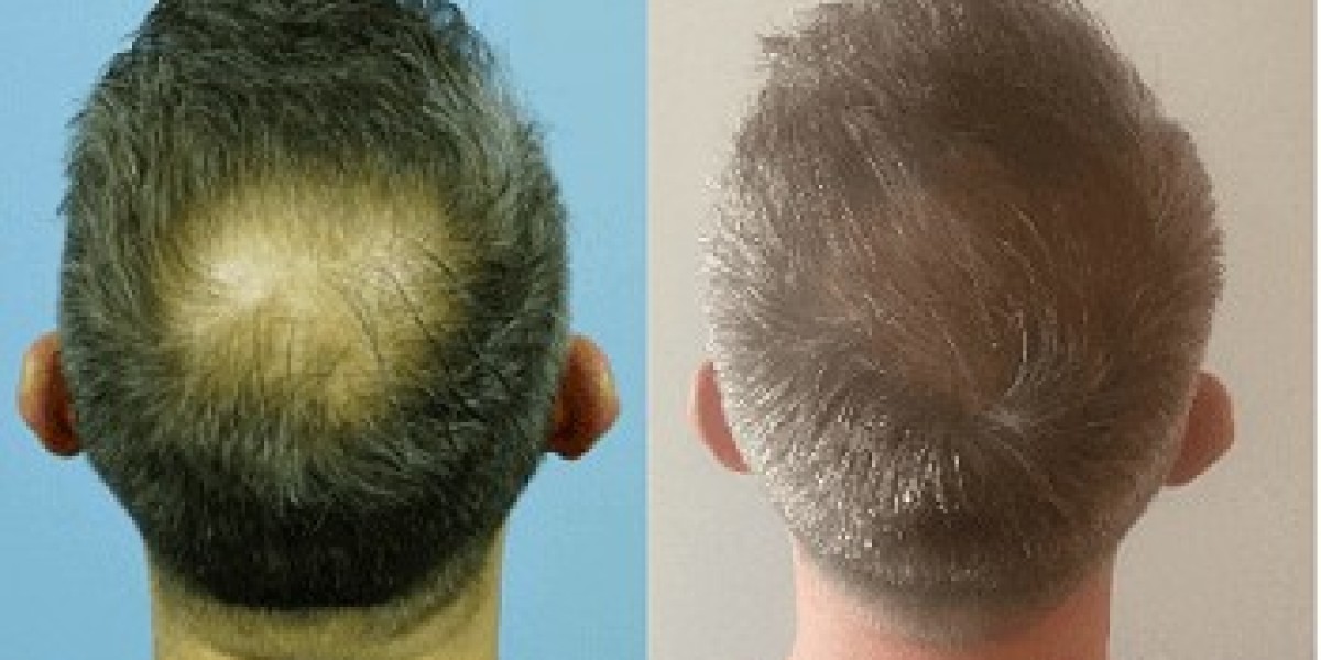 Saudi Arabia Hair Loss Exosome Help