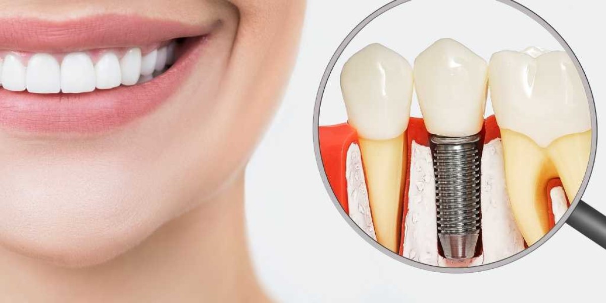 Transform Your Smile with Dental Implants