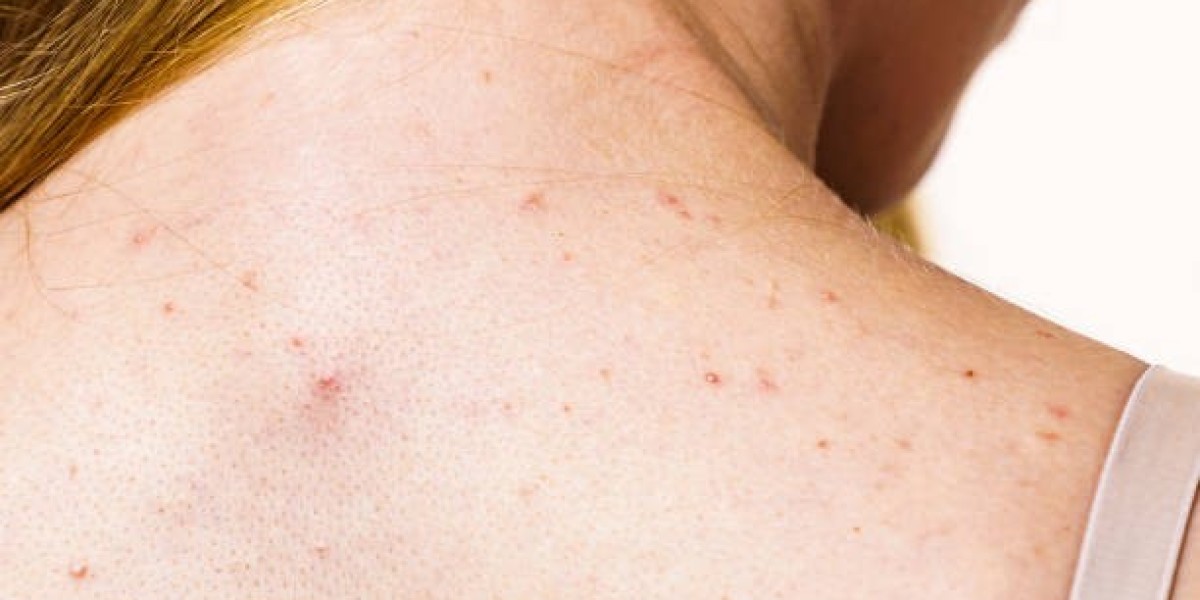What Home Remedies Can Help Treat Back Acne and Reduce Inflammation?