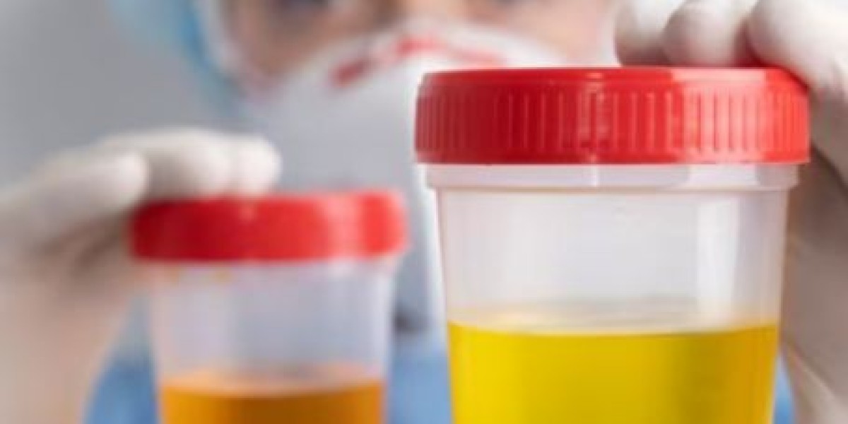 Urine Catecholamine Test: Diagnosing Adrenal Tumors and Hormone Imbalances