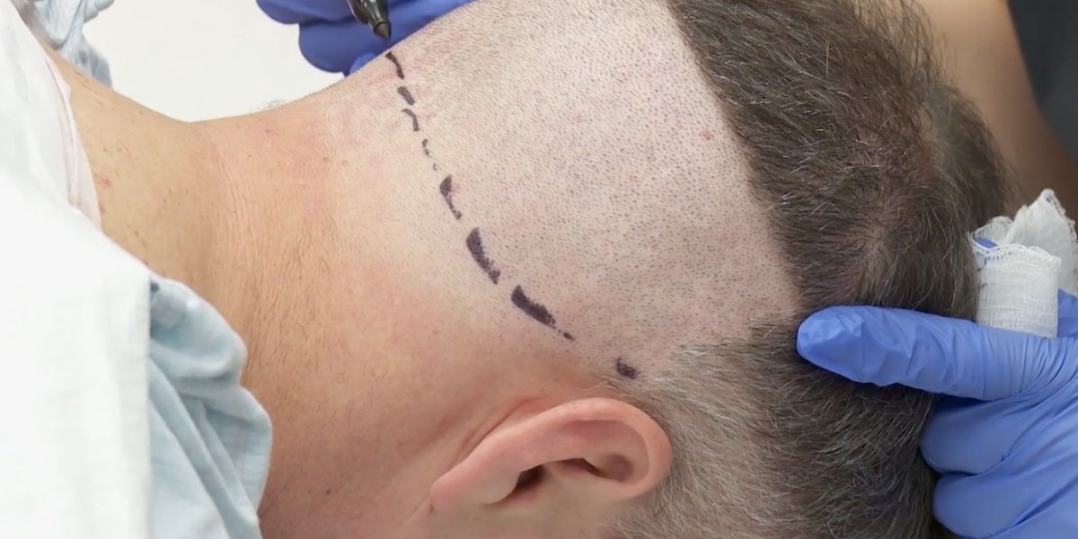 Hair Transplant Innovations Driving Modern Hair Growth Trends