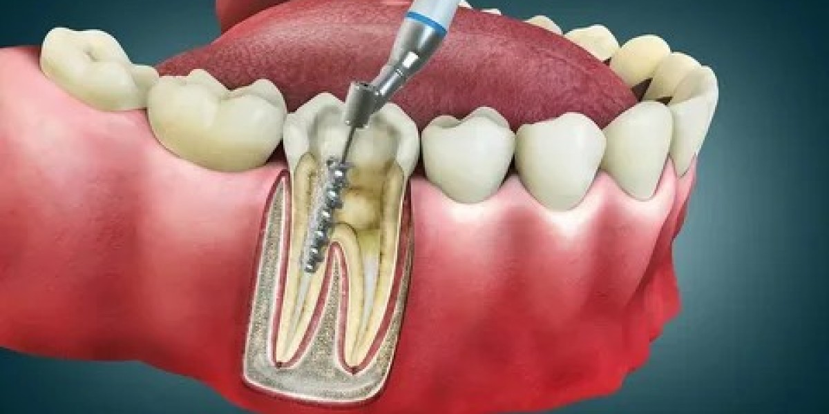 Do Root Canals Work for Deep Cavities? Islamabad Insights