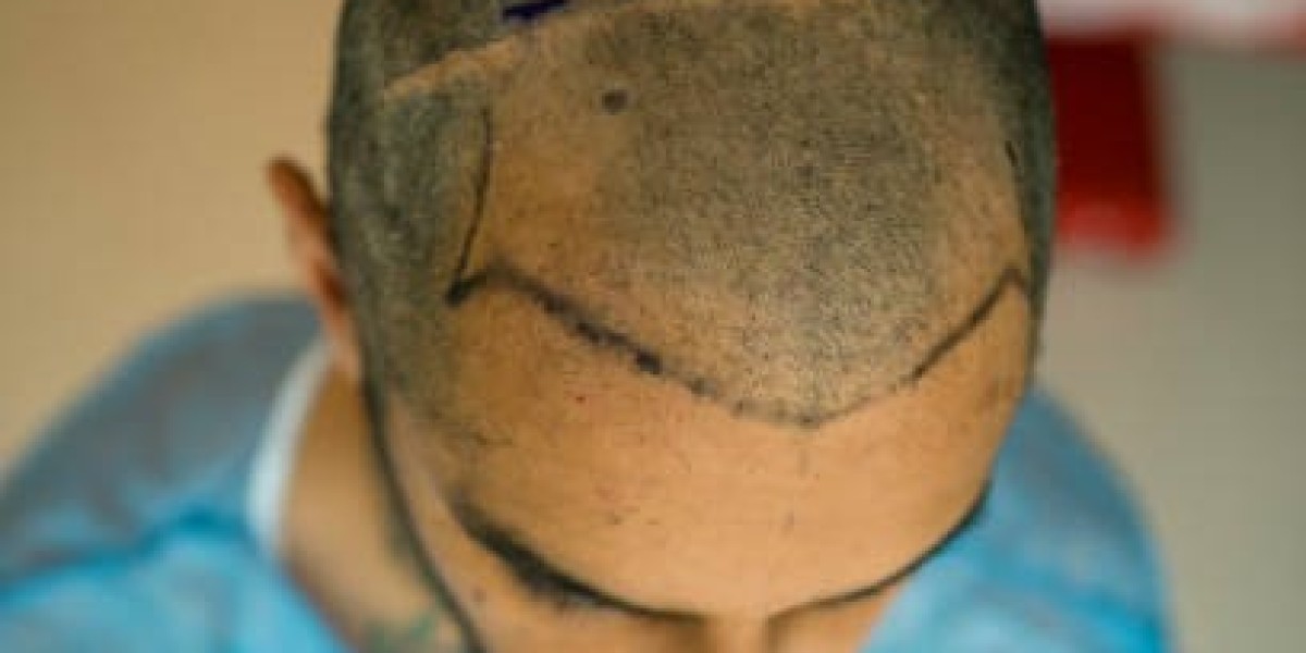 Long-Term Results of a 4000 or 5000 Grafts Hair Transplant
