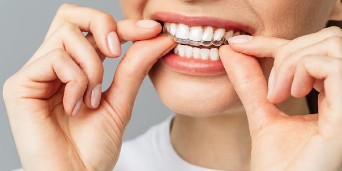 Invisible Braces - The Discreet Way to Straighten Your Smile
