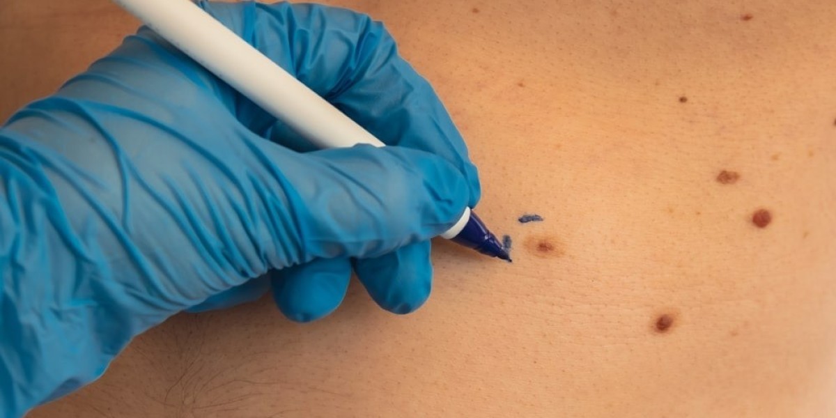 How Long Does Skin Tag Removal in Dubai Take?