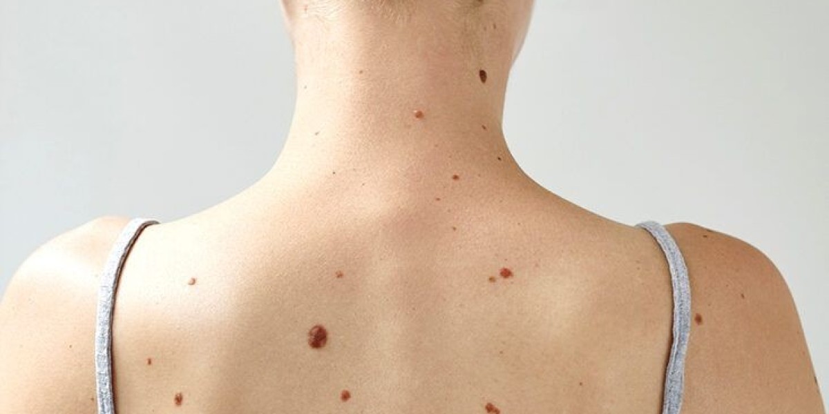 Can Mole Removal Affect Hair Growth?