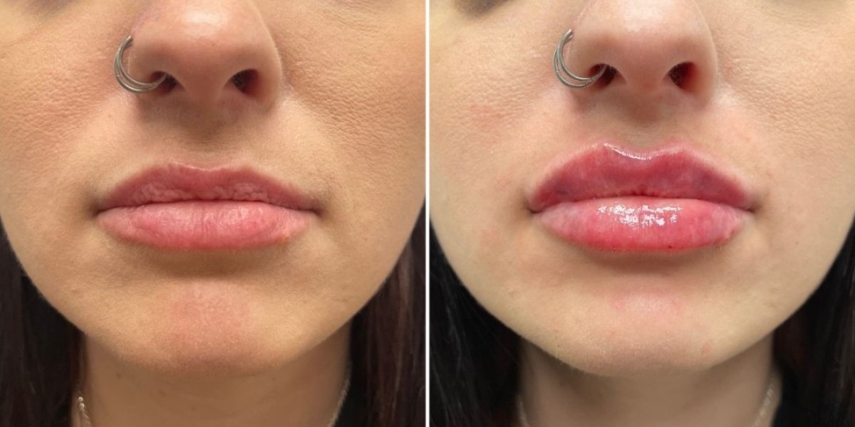 Lip Augmentation in Islamabad: A Beauty Upgrade