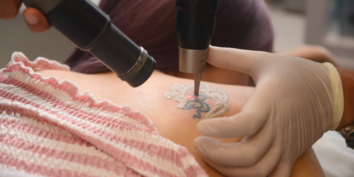 Will Laser Tattoo Removal make tattoos disappear fast?