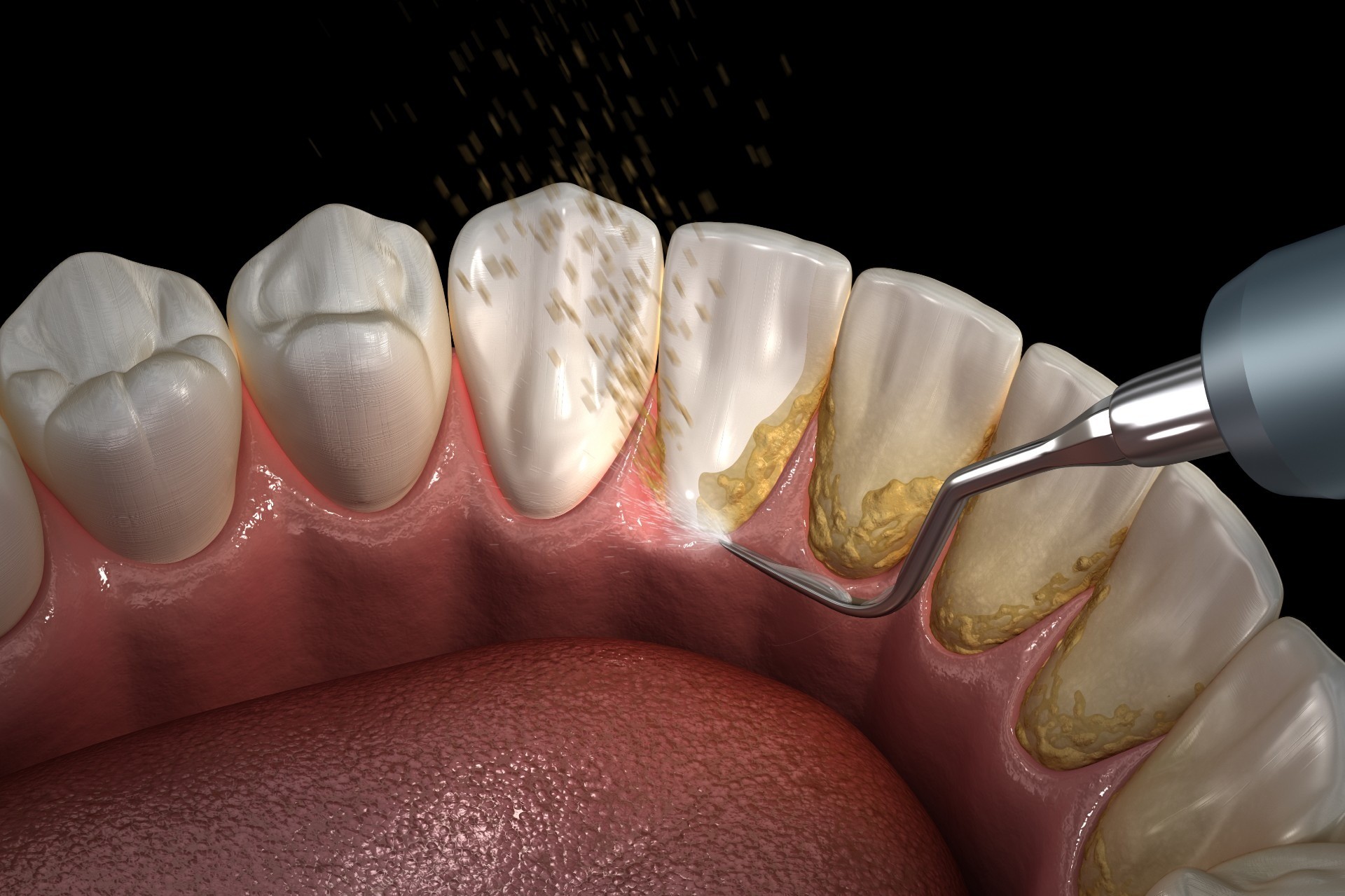Teeth Cleaning in Dubai