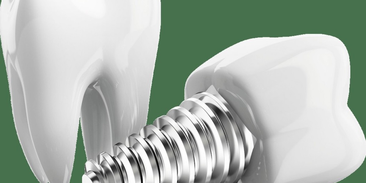 Top Reasons to Choose a Dental Implants Clinic in F7 for Long-Lasting Tooth Replacement