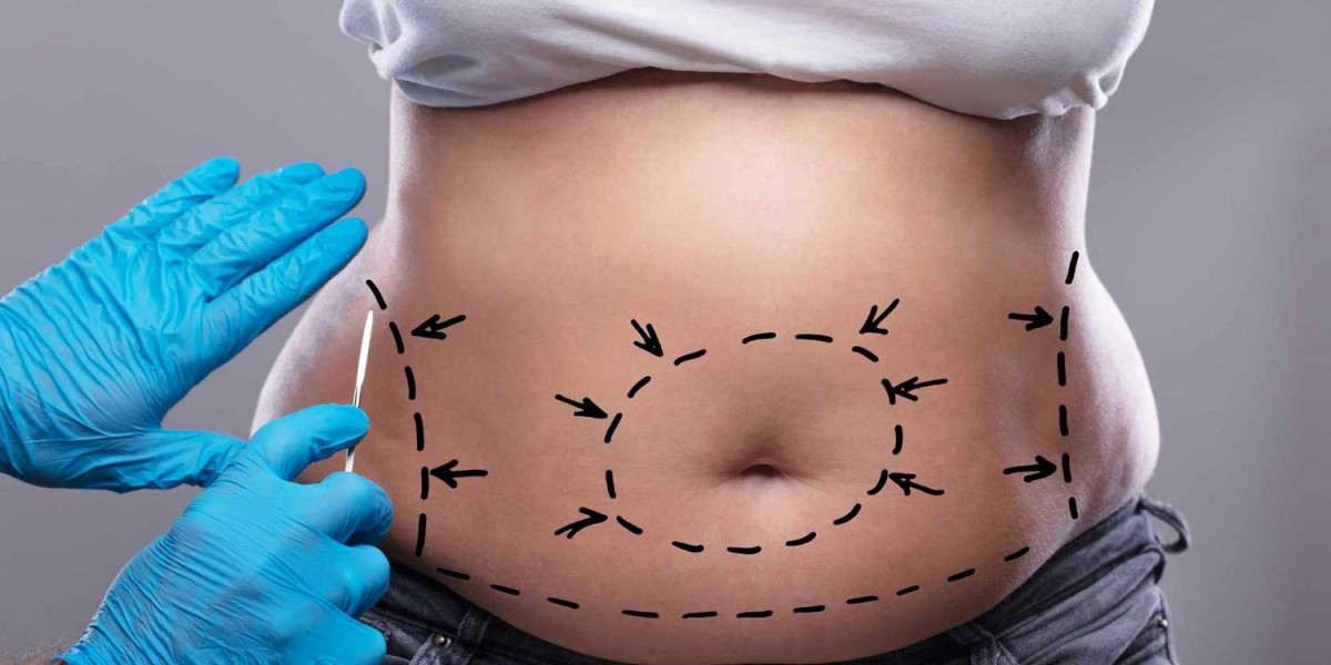 Can a Tummy Tuck Remove Excess or Loose Skin?