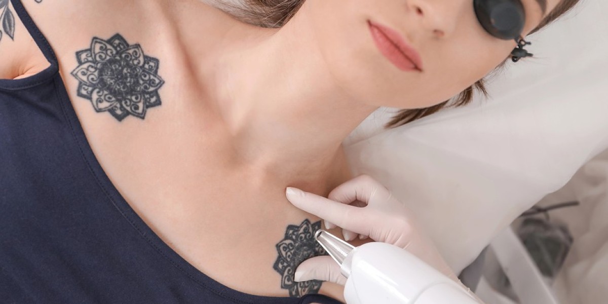 How Laser Tattoo Removal Can Boost Your Confidence
