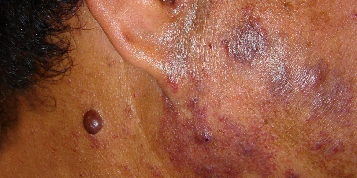 Can Children Safely Receive Port Wine Stain Treatment?