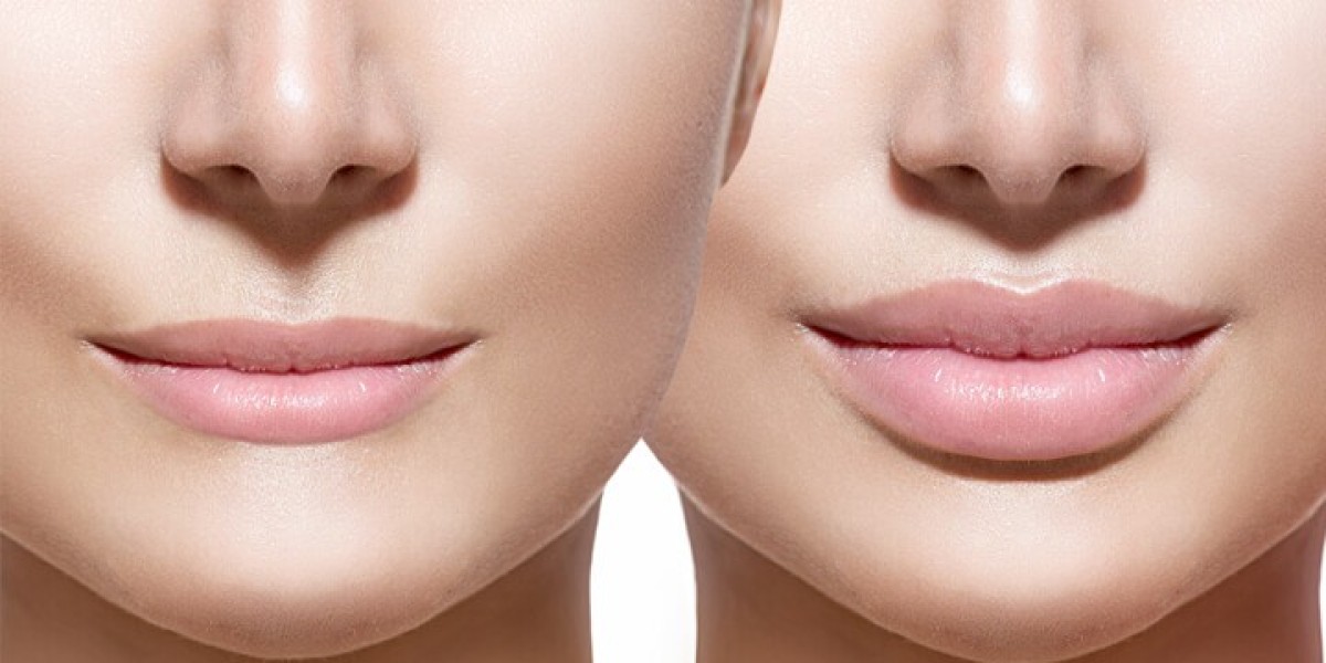 Benefits of Getting Lip Fillers in Dubai