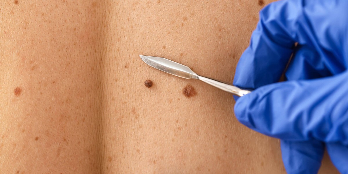 Can Laser Mole Removal Treat Large Moles?