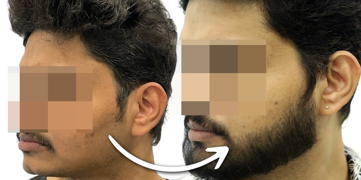 نتائج زراعة شعر اللحية قبل وبعد في الرياض