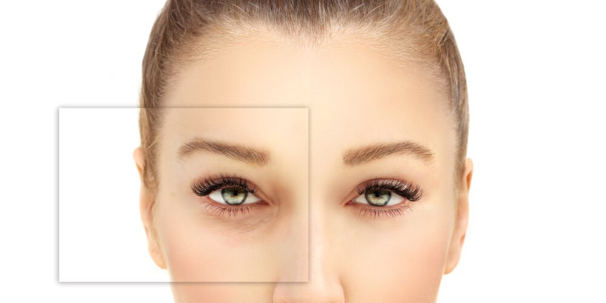 Top Reasons People in Islamabad Choose Blepharoplasty