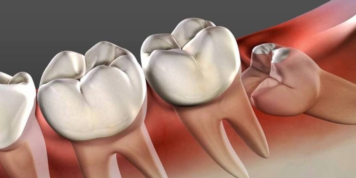 How Much Time Does Tooth Removal in Dubai Take?