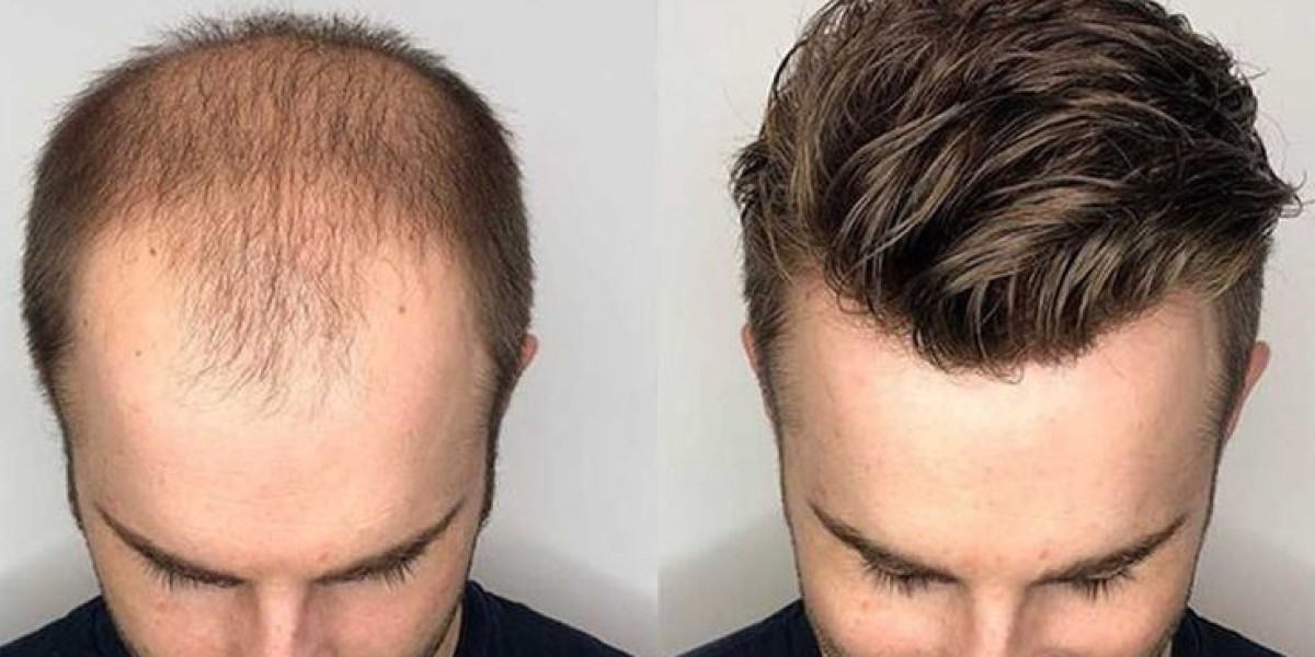 Advanced Hair Restoration in South Delhi