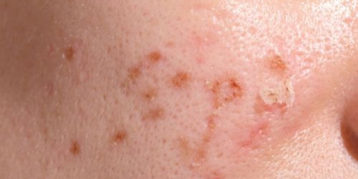 What Are the Main Benefits of Erbium Skin Peeling?
