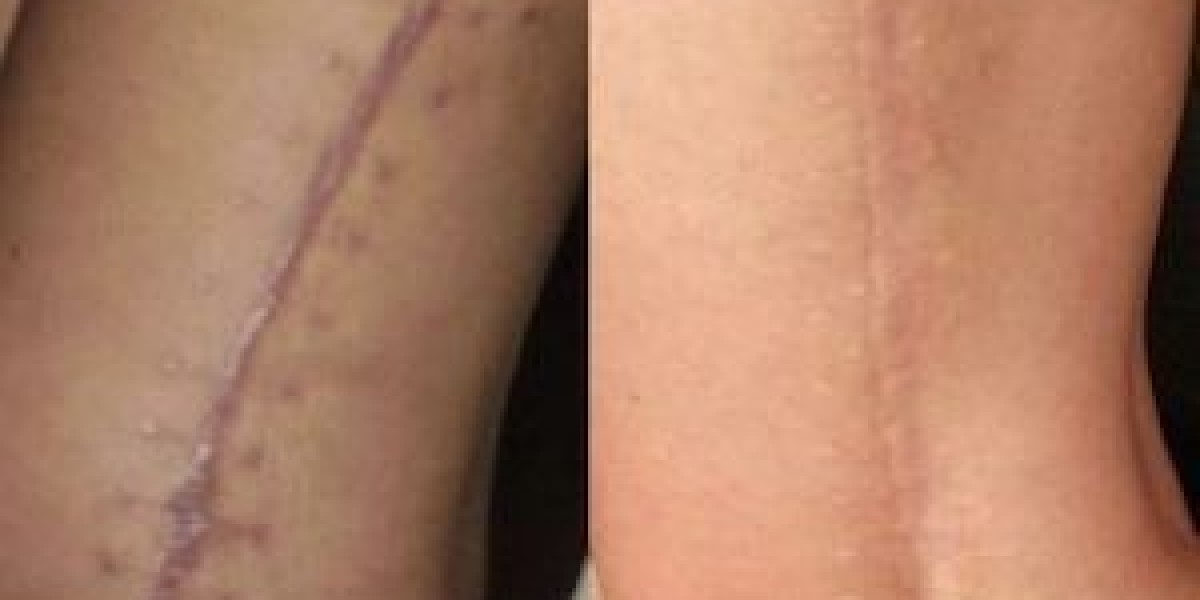 Scar Removal in Dubai: Affordable Options Without Compromising Quality