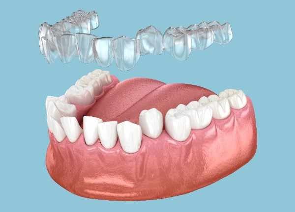invisalign Bracknell