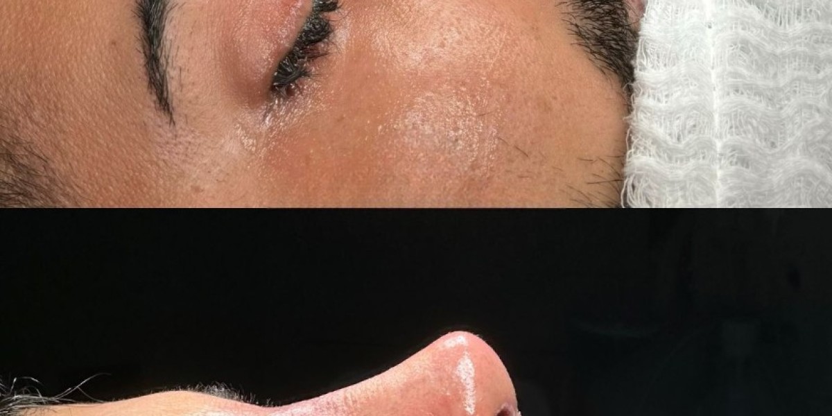 Enhance Your Facial Profile with Rhinoplasty in Islamabad