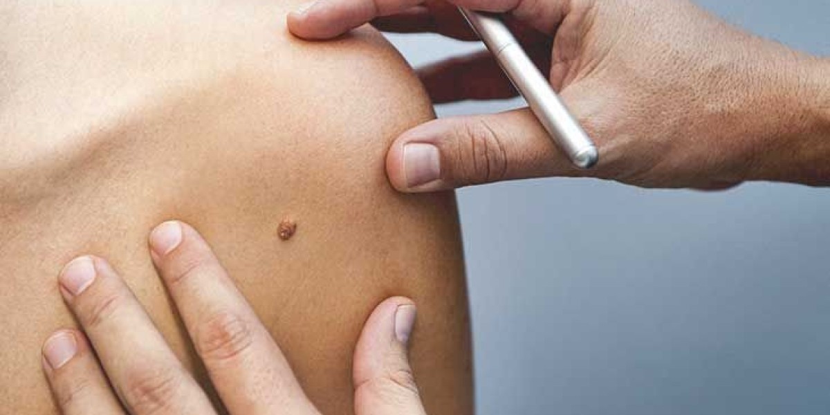 Is Mole Removal Safe for All Ages?