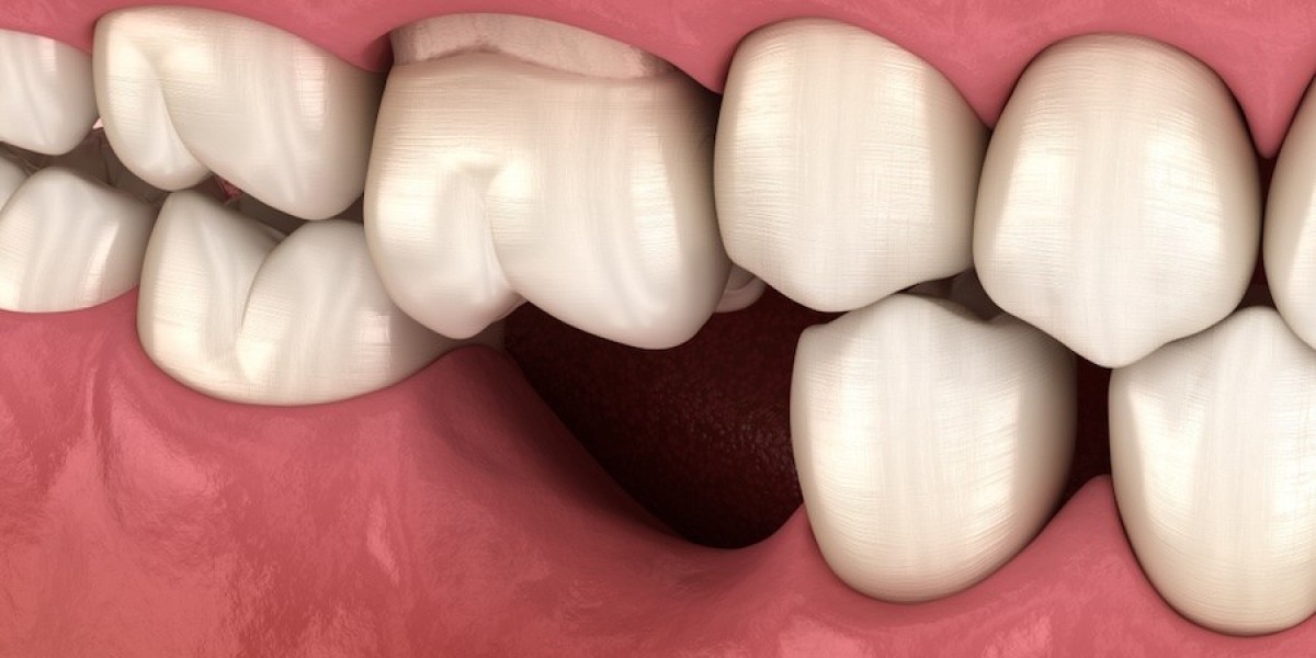 Understanding the Lifespan of Dental Crowns and Bridges