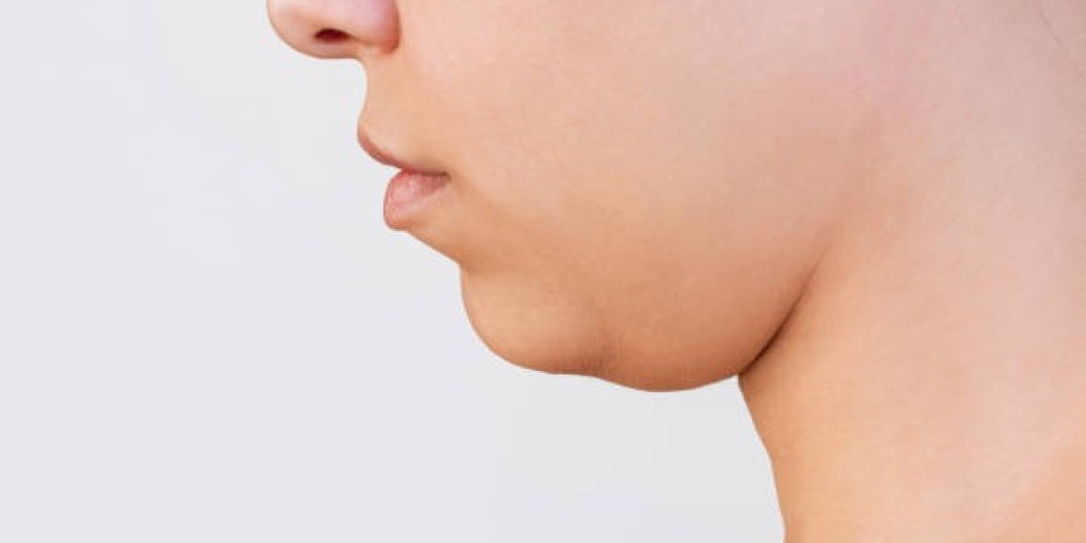 What Are the Alternatives to Double Chin Liposuction?