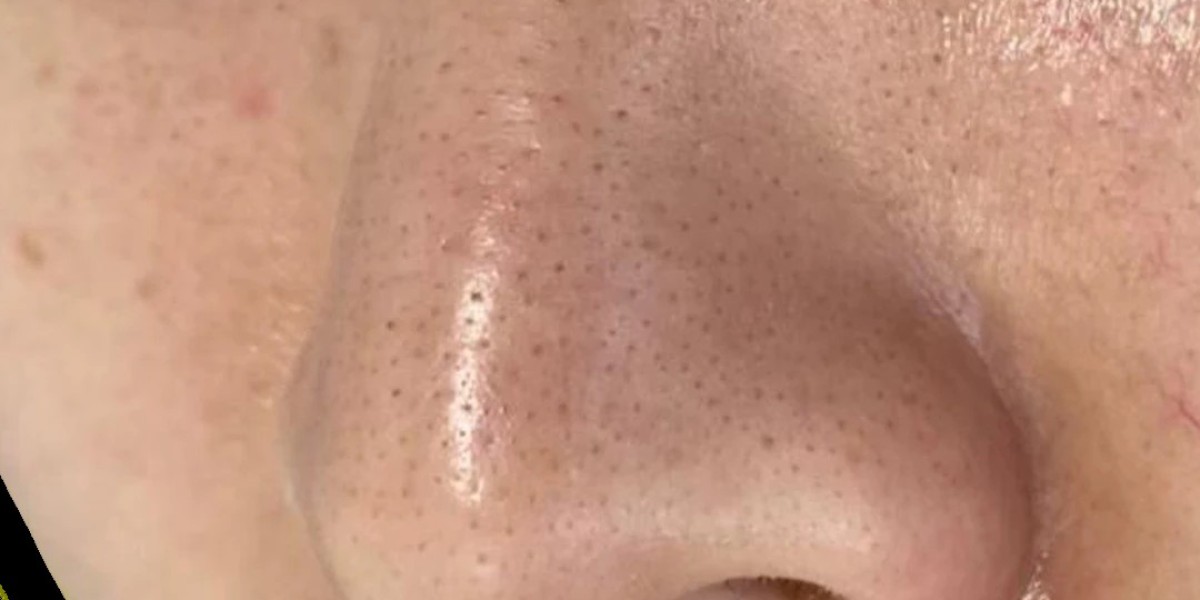 Does Dermapen Effectively Reduce Large Pores Fast?