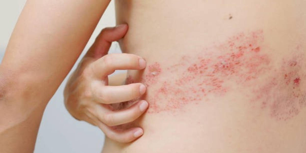 Shingles Treatment Options: Prescription vs. Over-the-Counter Solutions