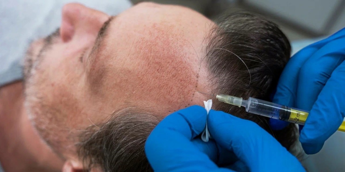 Common Side Effects of Hair Transplant in Islamabad