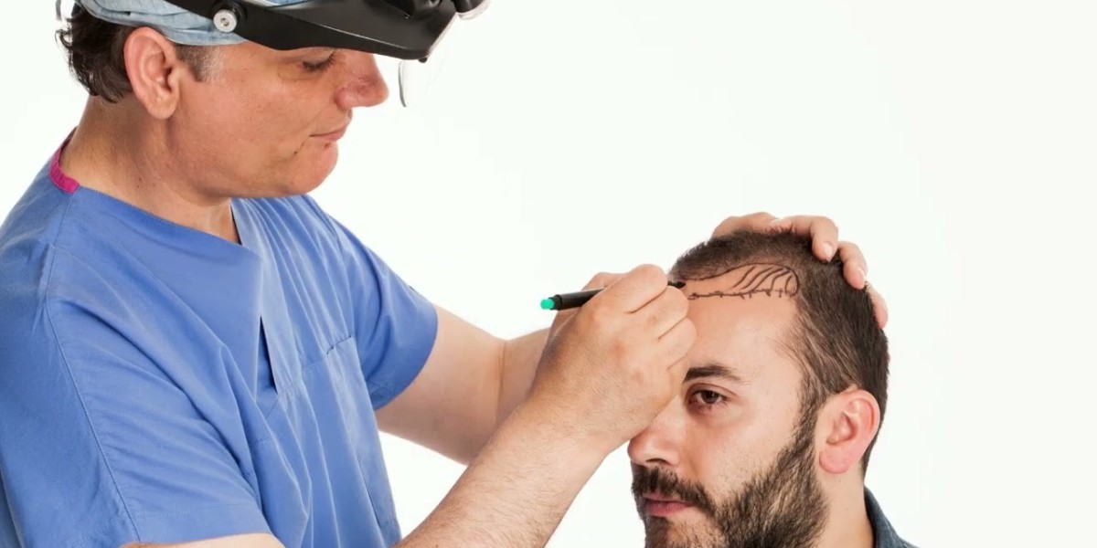 FUE Hair Transplant Cost Riyadh Explained