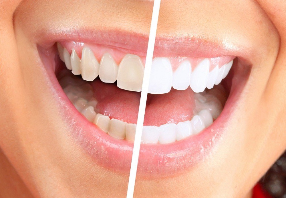 Teeth Cleaning in Dubai