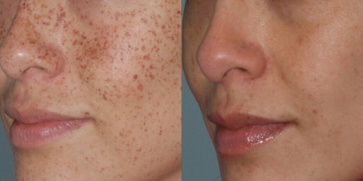How Diet and Lifestyle Influence Dermal Pigmentation Among Riyadh Locals