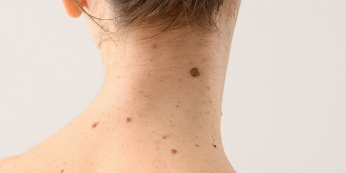 The Science Behind Mole Removal in Dubai: Understanding the Procedure