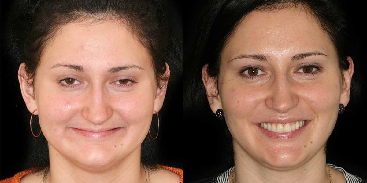 Bite Correction Surgery in Islamabad: Your Complete Guide