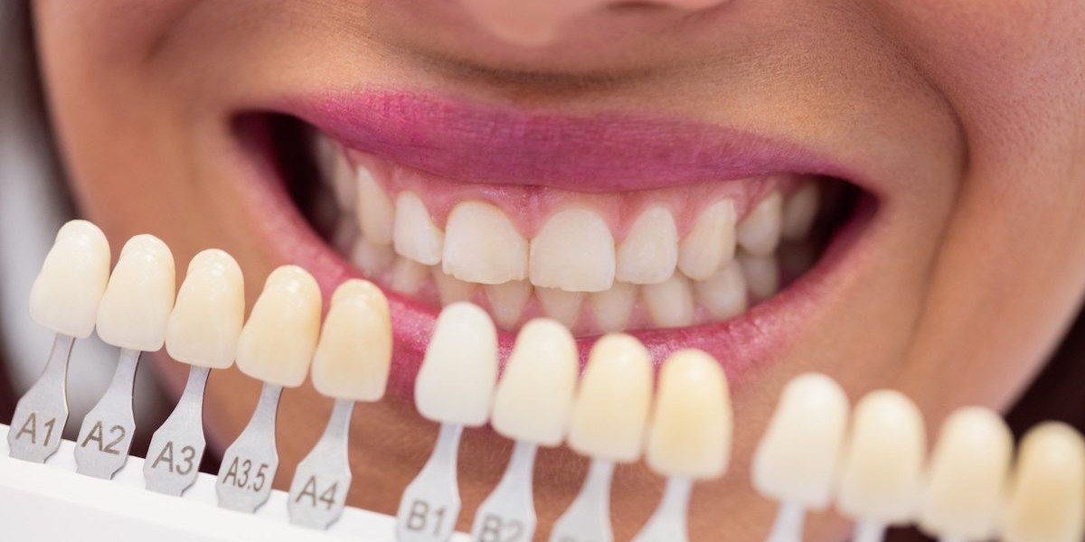 What Are Composite Veneers? A Complete Beginner’s Guide