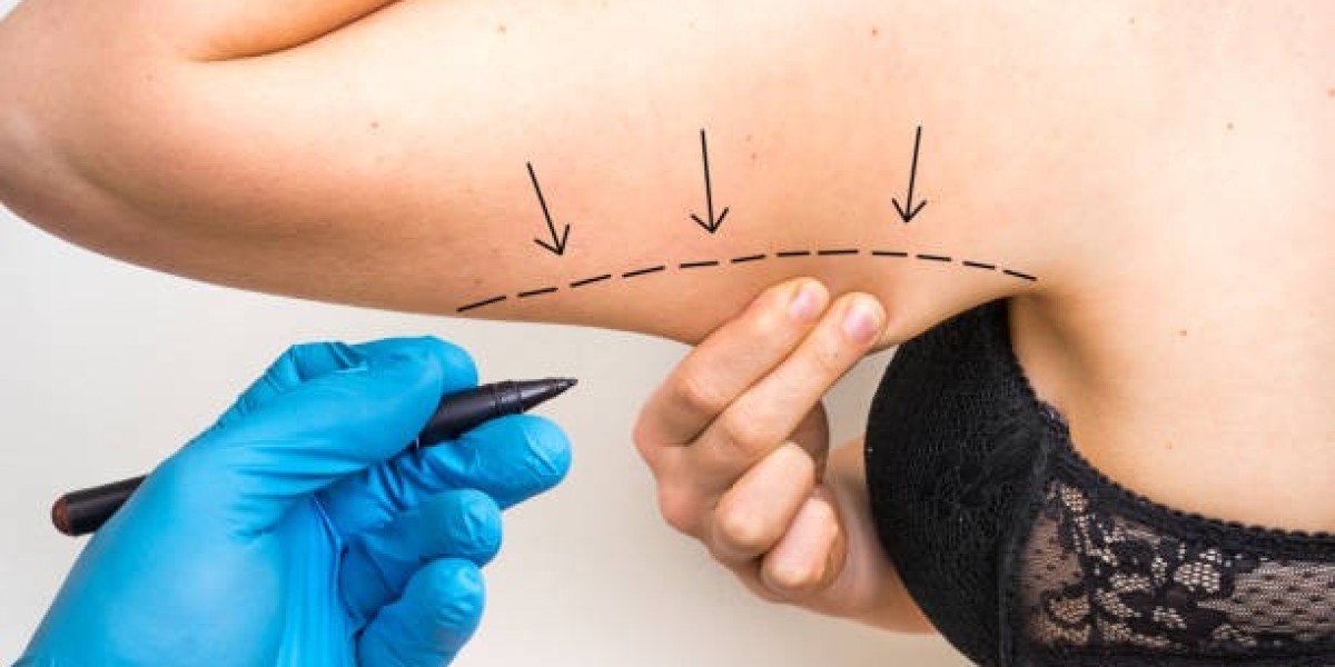 How Liposuction in Riyadh Can Boost Confidence and Body Image