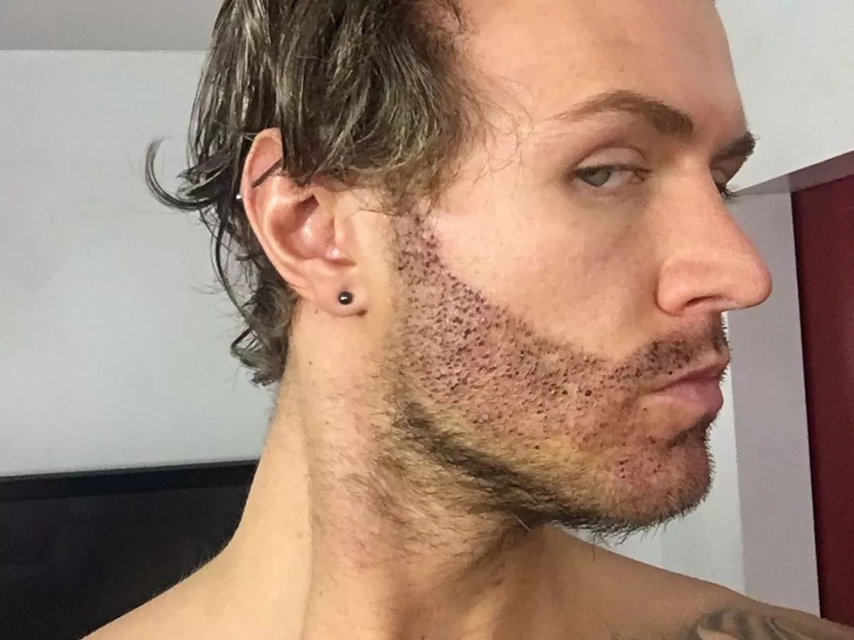 Beard Hair Transplant in Dubai