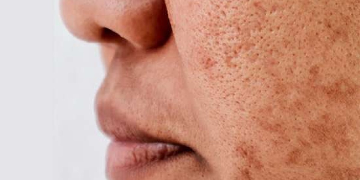 Can Erbium Peel Treat Pigmentation and Dark Spots?