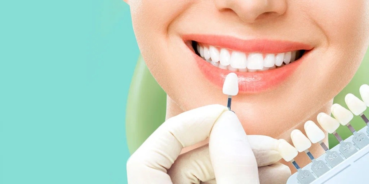 Dental Veneers for Chipped or Broken Teeth in Islamabad
