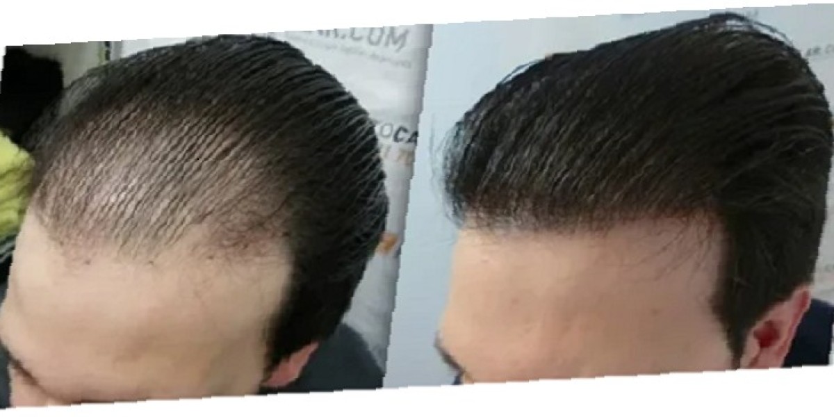 How to Prepare for Your Hair Transplant Journey