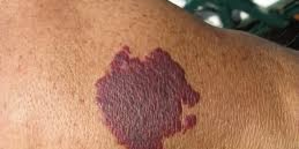 What Is the Best Age for Birthmark Removal Treatment?