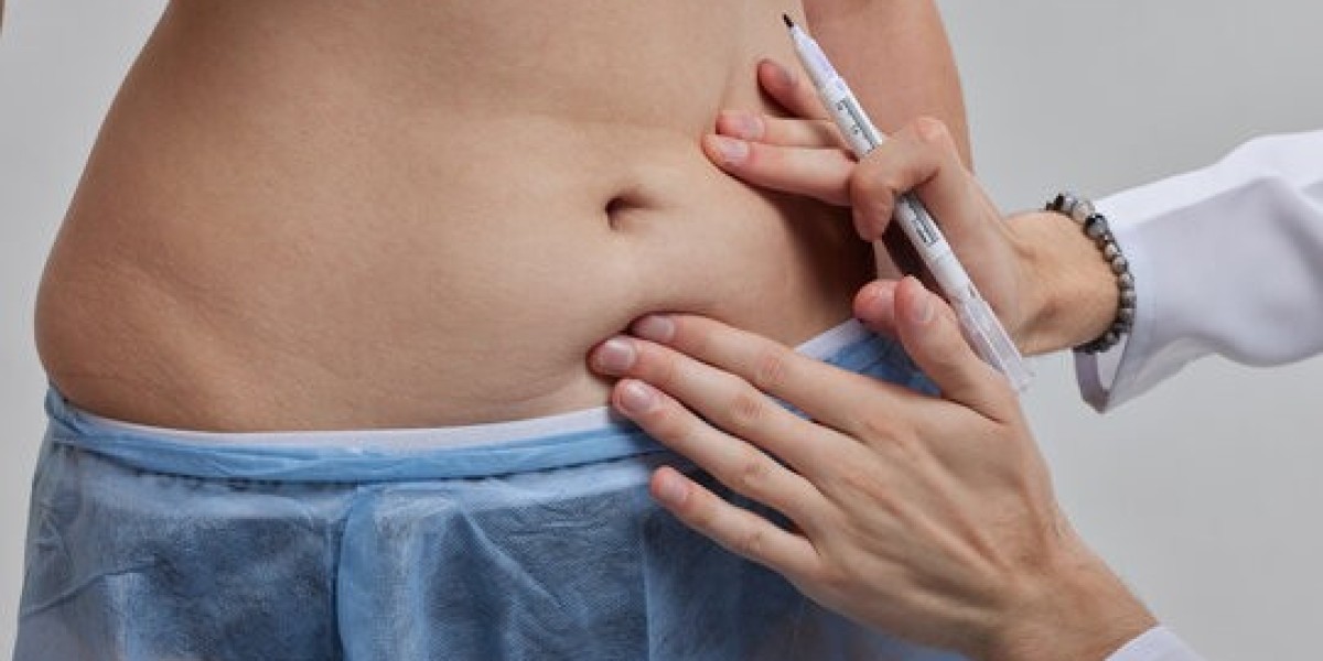 Achieve Your Ideal Body with Expert Liposuction in Islamabad