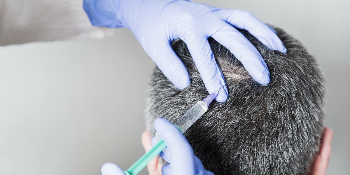 The Complete Guide to PRP Hair Treatment in Islamabad