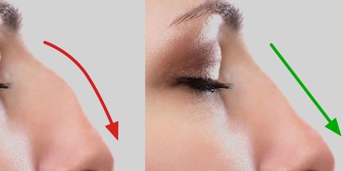 Revision Rhinoplasty in Dubai: Correcting and Perfecting Past Surgeries