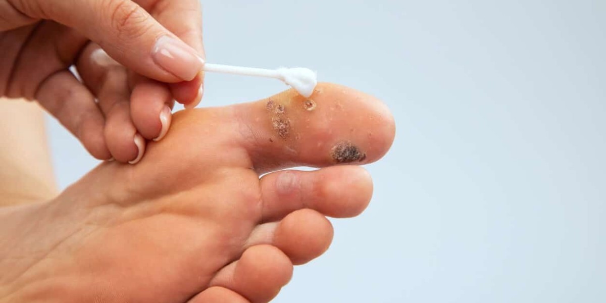 Skin Wart Removal Cost: Laser vs. Freezing