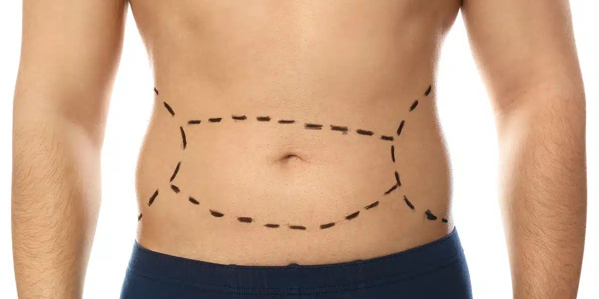 Can Men Also Benefit from a Tummy Tuck Procedure?